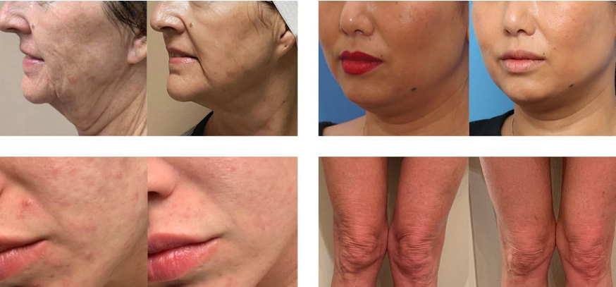 Mapa corporal com áreas que podem ser tratadas com Morpheus